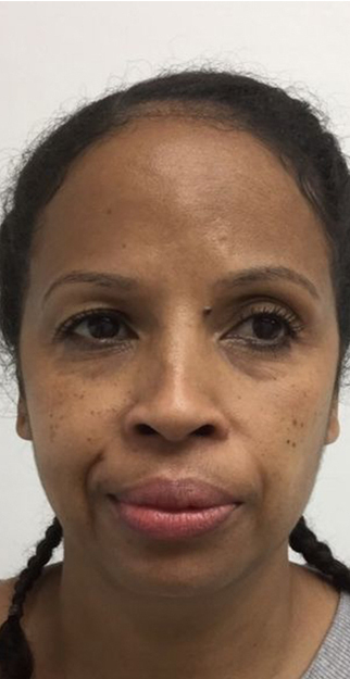 See incredible before & after results from our Botox, fillers & skin treatments in Clapham & Belgravia.